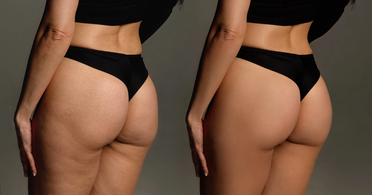 Women showing Before and after results of Sculptra BBL in Annapolis, MD, showing enhanced curves and natural volume improvement.