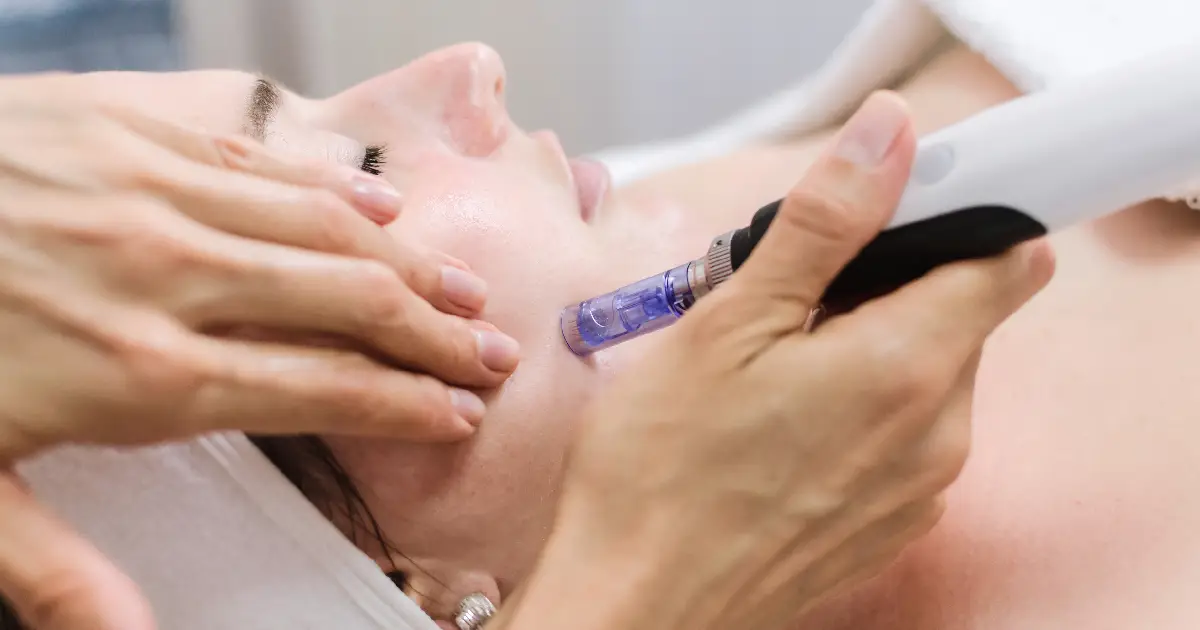 Top Acne Scar Treatments in Annapolis, MD: What Works Best?