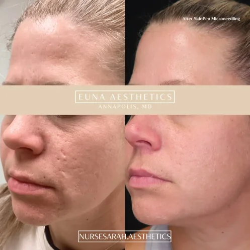 After SkinPen Microneedling