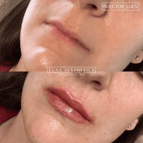 Derma Filler- Lips (1)