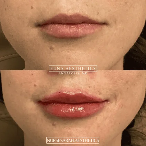 Derma Filler- Lips (2)