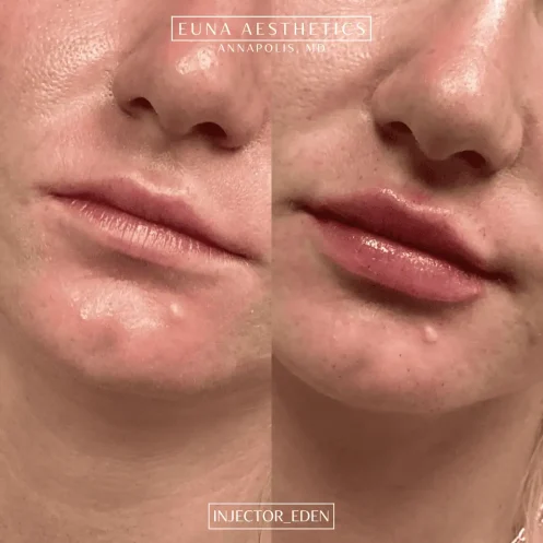 Derma Filler- Lips (3)