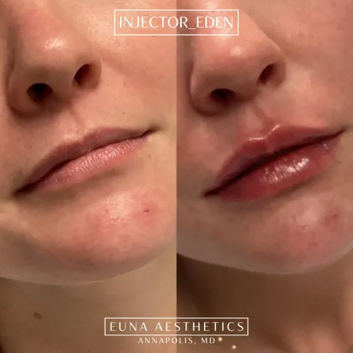 Helloeuna_Dermal filler lips_Thirteen_In_Annapolis_MD