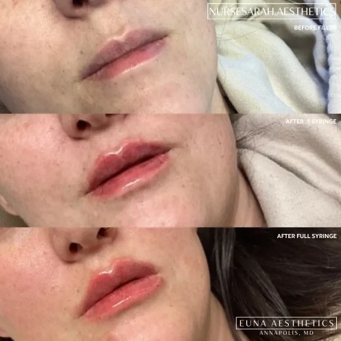 Helloeuna_Dermal filler lips_Three_In_Annapolis_MD