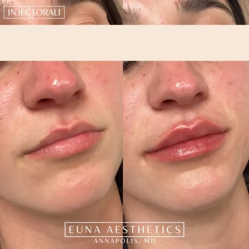 Helloeuna_Dermal filler lips_Tw_In_Annapolis_MD