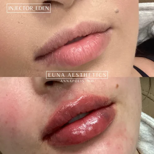 Helloeuna_Dermal filler lips_Twelve_In_Annapolis_MD