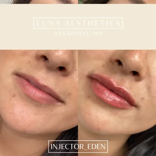 Helloeuna_Dermal filler lips_Two _In_Annapolis_MD