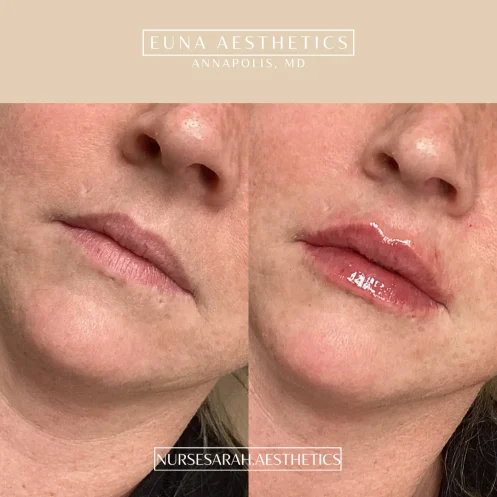 Helloeuna_Dermal filler lips_Two1_In_Annapolis_MD