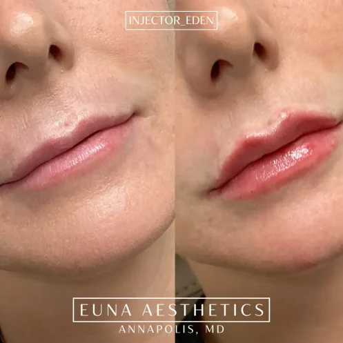 Helloeuna_Dermal filler lips_Two_ In_Annapolis_MD