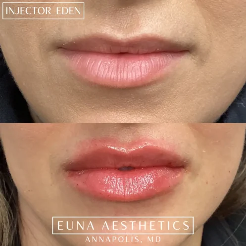 Helloeuna_Dermal filler lips_Two_In_Annap olis_MD