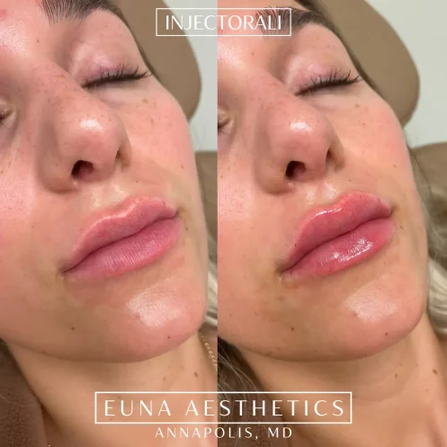 Helloeuna_Dermal filler lips_Two_In_Annapolis_MD