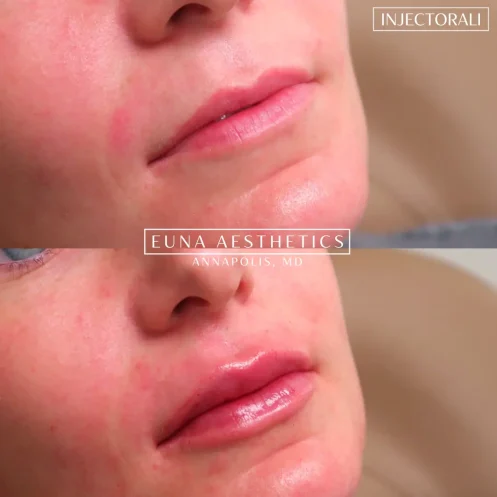 Helloeuna_Dermal filler lips_Two_In_Annapolis_MD0