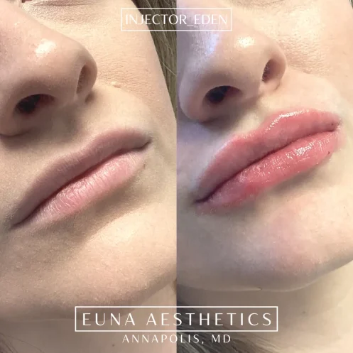 Helloeuna_Dermal filler lips_Two_In_Annapolis_MD1