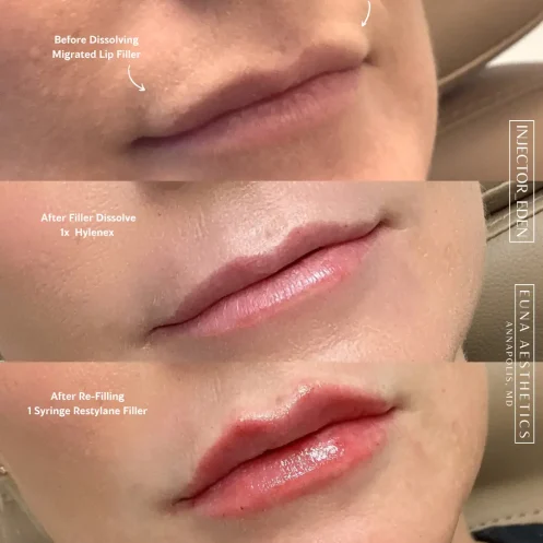 Helloeuna_Dermal filler lips_Two_In_Annapolis_MD2