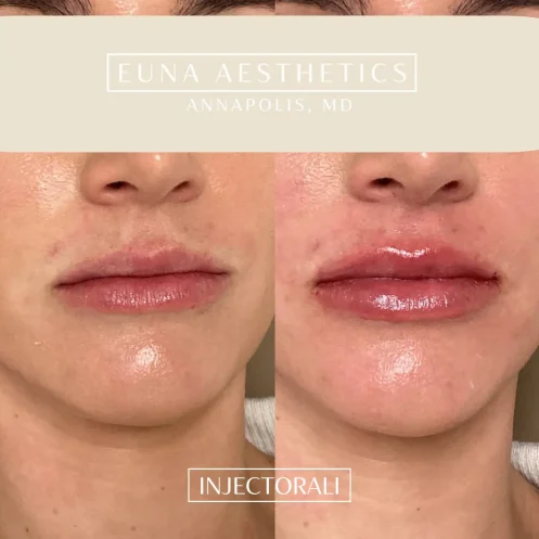 Helloeuna_Dermal filler lips_Two_In_Annapolis_MD6