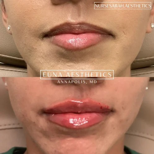 Helloeuna_Dermal filler lips_Two_In_Annapolis_MD7