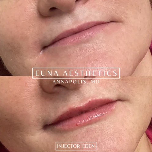 Helloeuna_Dermal filler lips_Two_In_Annapolis_MD8