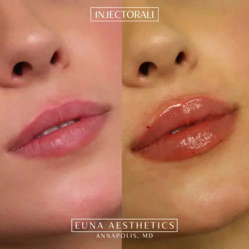 Helloeuna_Dermal filler lips_Two_In_Annapolis_MD9