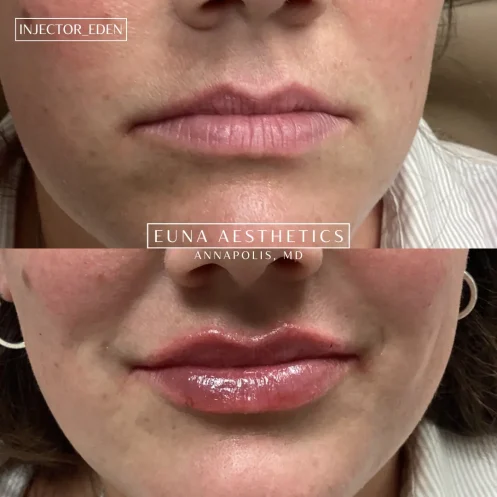 Helloeuna_Dermal filler lips_Two_In_Annapolis_MDf