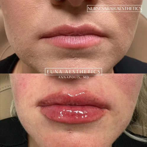 Helloeuna_Dermal filler lips_eight_In_Annapolis_MD