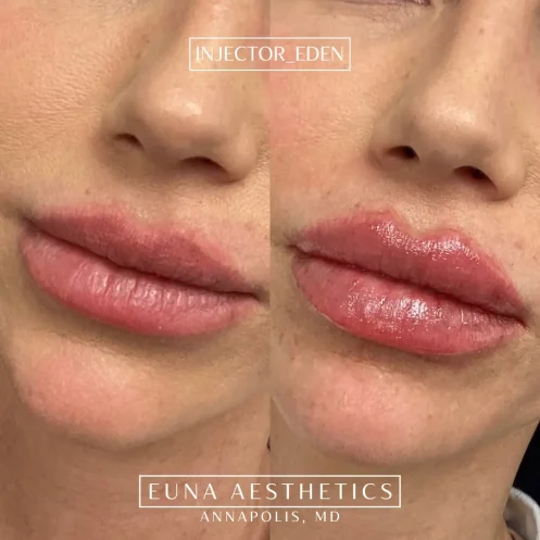 Helloeuna_Dermal filler lips_eighteen_In_Annapolis_MD