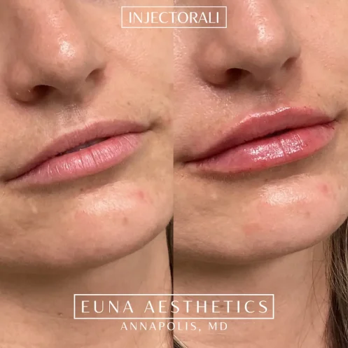 Helloeuna_Dermal filler lips_eleven_In_Annapolis_MD