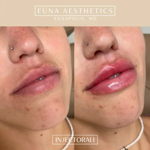 Helloeuna_Dermal filler lips_five_In_Annapolis_MD