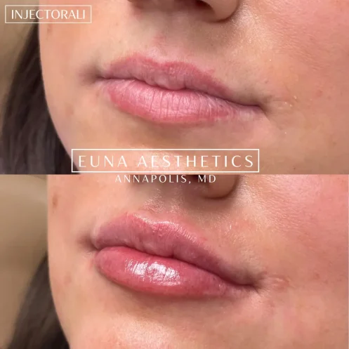 Helloeuna_Dermal filler lips_four_In_Annapolis_MD