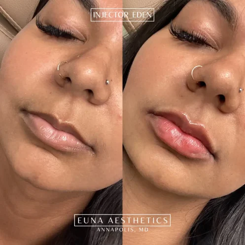 Helloeuna_Dermal filler lips_fourteen_In_Annapolis_MD