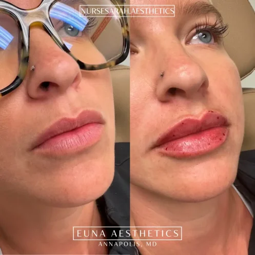 Helloeuna_Dermal filler lips_night_In_Annapolis_MD