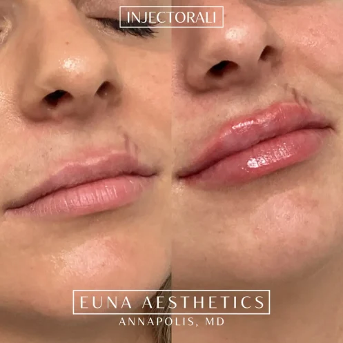 Helloeuna_Dermal filler lips_nighteen_In_Annapolis_MD