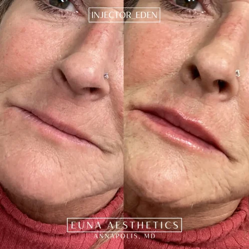 Helloeuna_Dermal filler lips_seventeen_In_Annapolis_MD