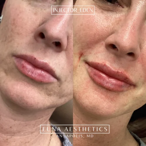 Helloeuna_Dermal filler lips_sixteen_In_Annapolis_MD