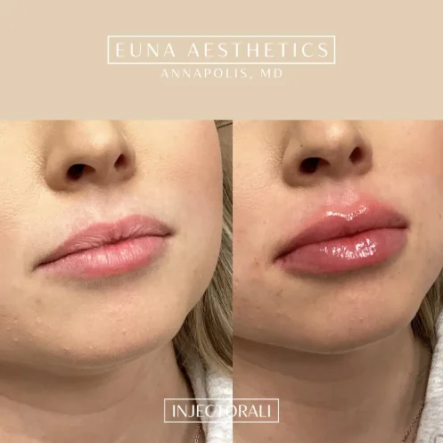 Helloeuna_Dermal filler lips_ten_In_Annapolis_MD