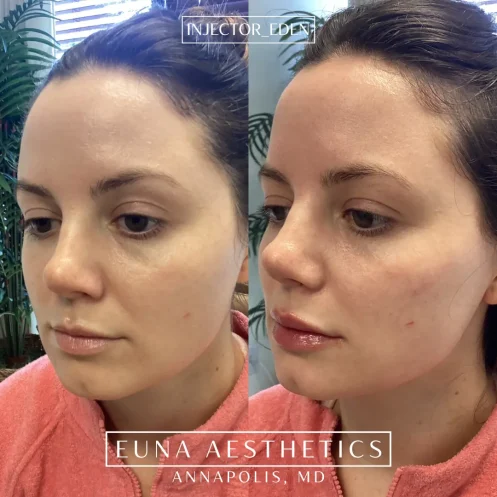 Helloeuna_Dermal filler_Three_In_Annapolis_MD