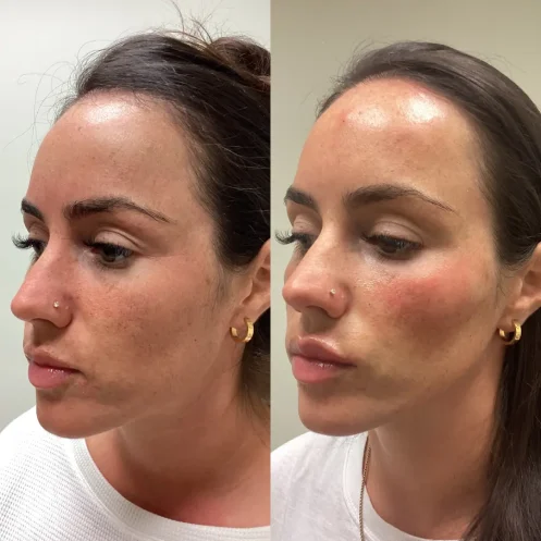 Helloeuna_Dermal filler_Two_In_Annapolis_MD