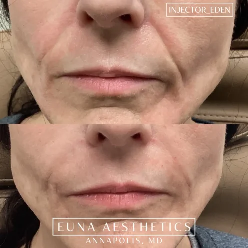 Helloeuna_Dermal filler_Two_In_Annapolis_MD3