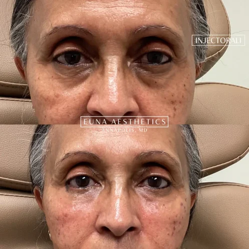 Helloeuna_Dermal filler_Two_In_Annapolis_MD4