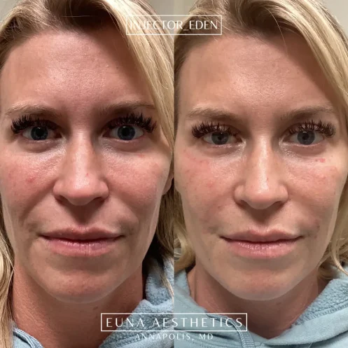 Helloeuna_Dermal filler_Two_In_Annapolis_MD6