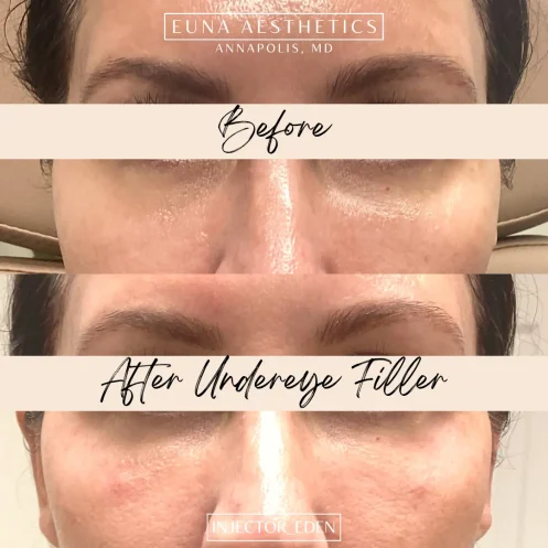 Helloeuna_Dermal filler_eight_In_Annapolis_MD