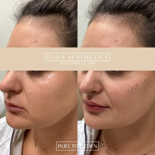 Helloeuna_Dermal filler_eleven_In_Annapolis_MD