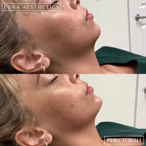 Helloeuna_Dermal filler_five_In_Annapolis_MD