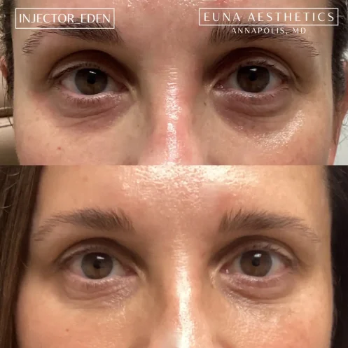 Helloeuna_Dermal filler_four_In_Annapolis_MD