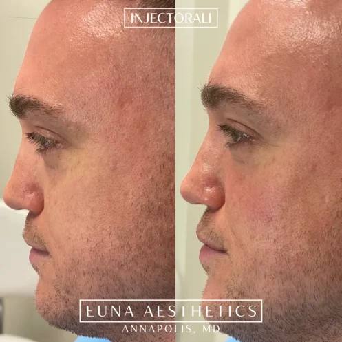 Helloeuna_Dermal filler_nine_In_Annapolis_MD