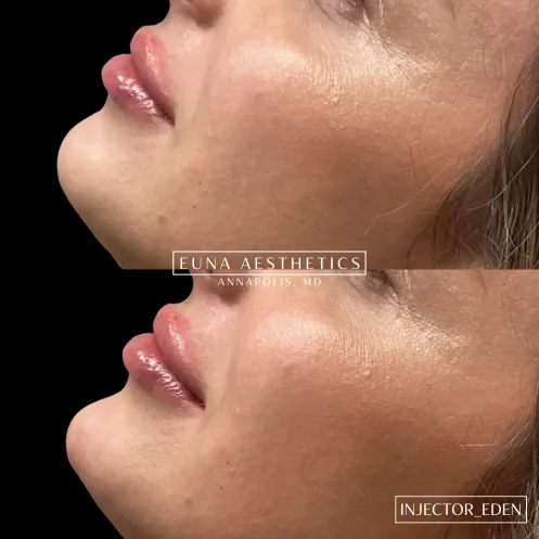 Helloeuna_Dermal filler_seven_In_Annapolis_MD