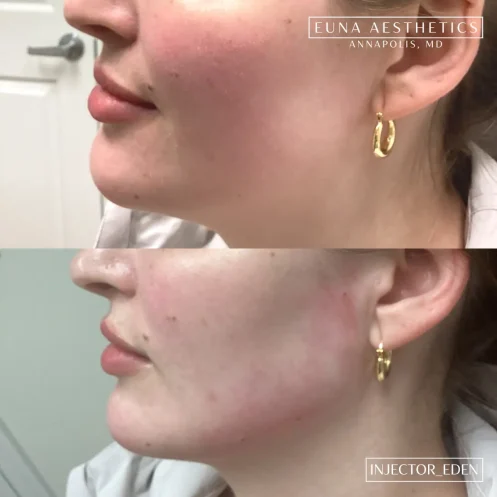 Helloeuna_Dermal filler_six_In_Annapolis_MD