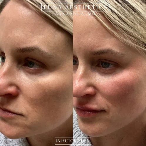 Helloeuna_Dermal filler_ten_In_Annapolis_MD