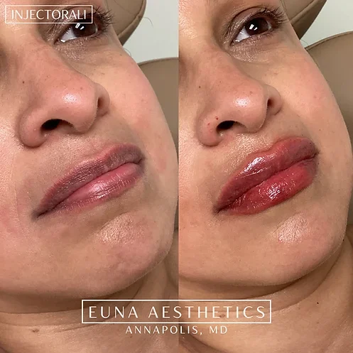 Helloeuna_Dermal_Filler_Eight by Euna Aesthetics LLC in Annapolis, MD