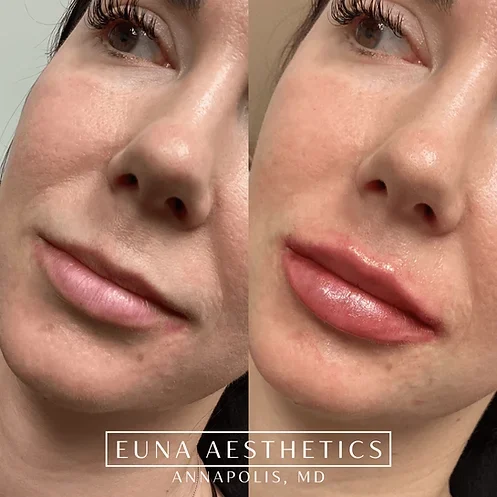 Helloeuna_Dermal_Filler_Five by Euna Aesthetics LLC in Annapolis, MD