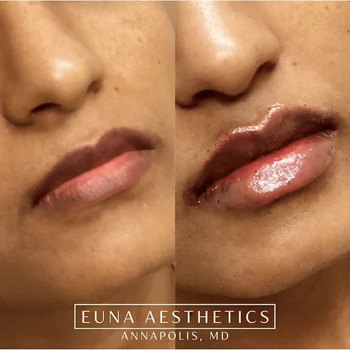 Helloeuna_Dermal_Filler_Four by Euna Aesthetics LLC in Annapolis, MD